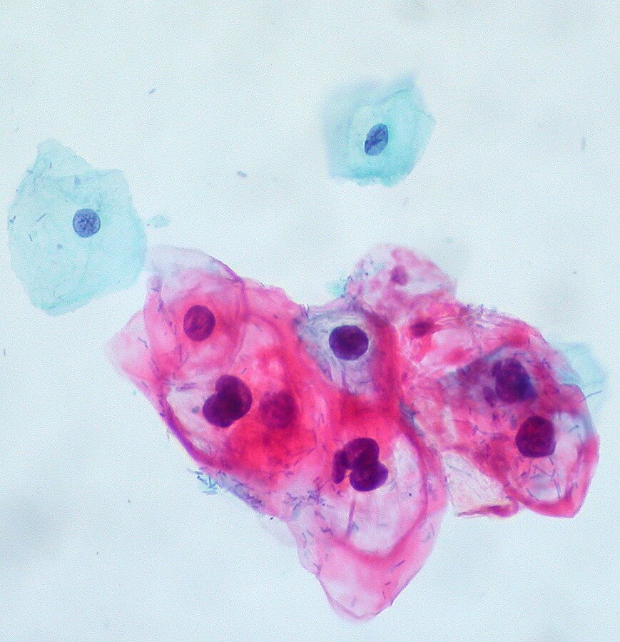 Cervical Cancer Prevention & Treatment. CIN-1 dysplastic lesion caused by HPV infection