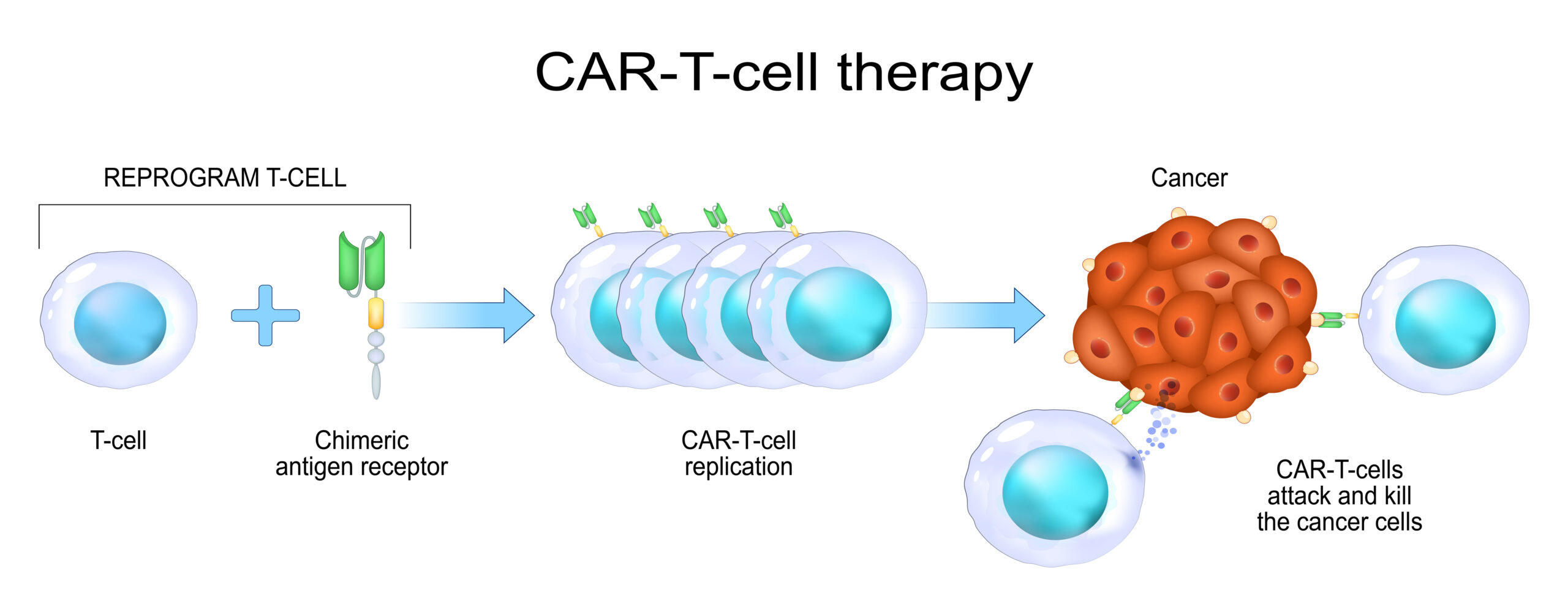 Mechanism of action of CAR-T therapy.