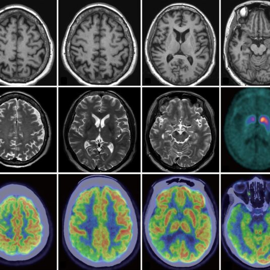 Serotonergic mechanisms responsible for levodopa-induced dyskinesias in Parkinson’s disease patients.
