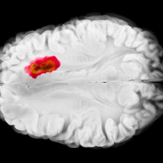 Illustration of a glioblastoma in brain