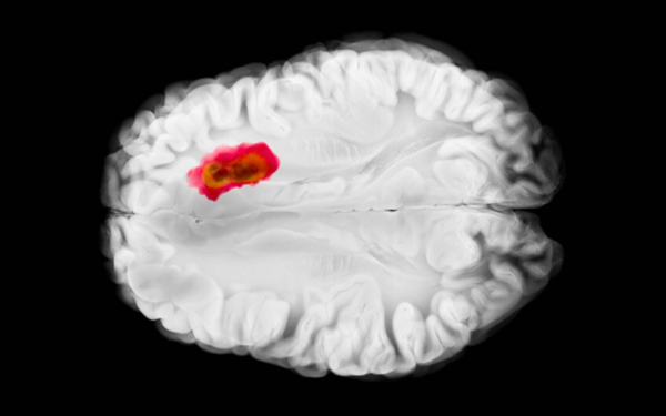 Illustration of a glioblastoma in brain